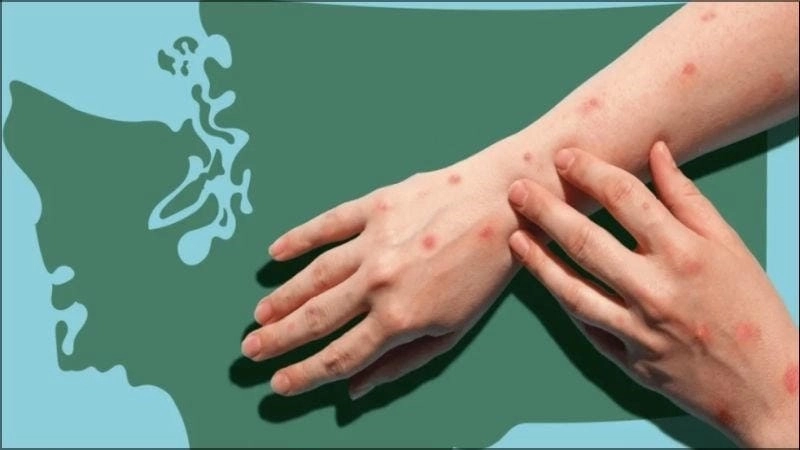 Dấu hiệu nhận biết sớm bệnh đậu mùa khỉ