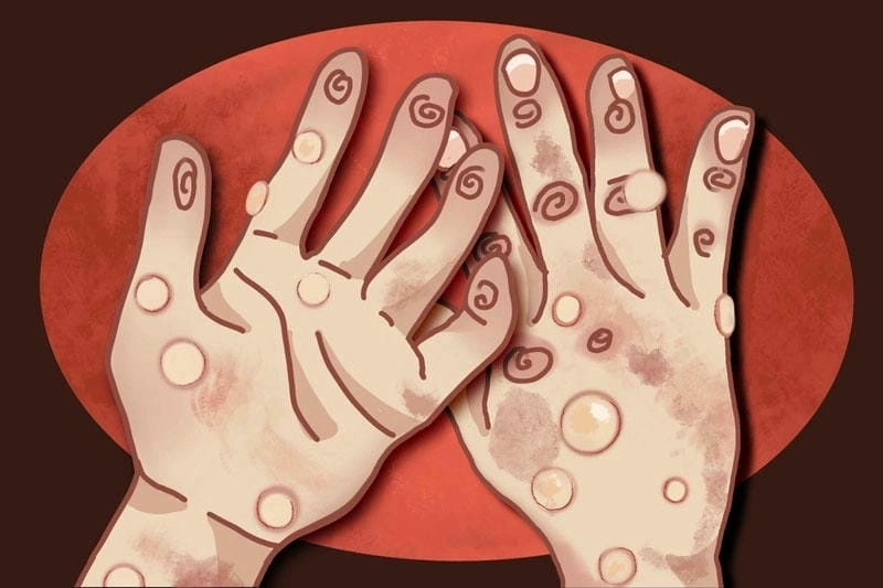 Hình ảnh đậu mùa khỉ qua từng giai đoạn