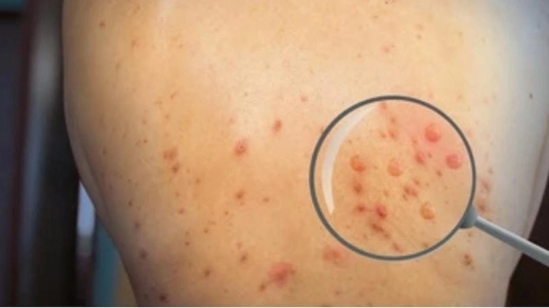 Hình ảnh tuyên truyền phòng bệnh đậu mùa khỉ