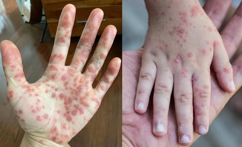 Hình ảnh trực quan về đậu mùa khỉ