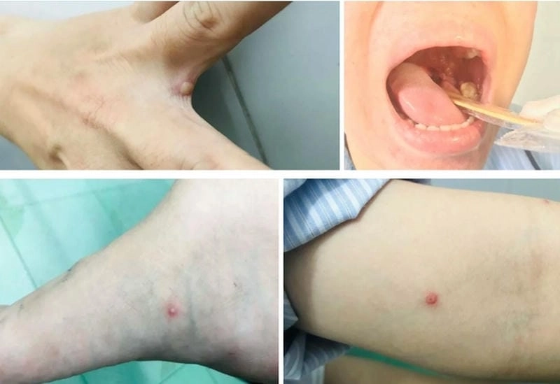 Hình ảnh dịch đậu mùa khỉ tại nhiều khu vực