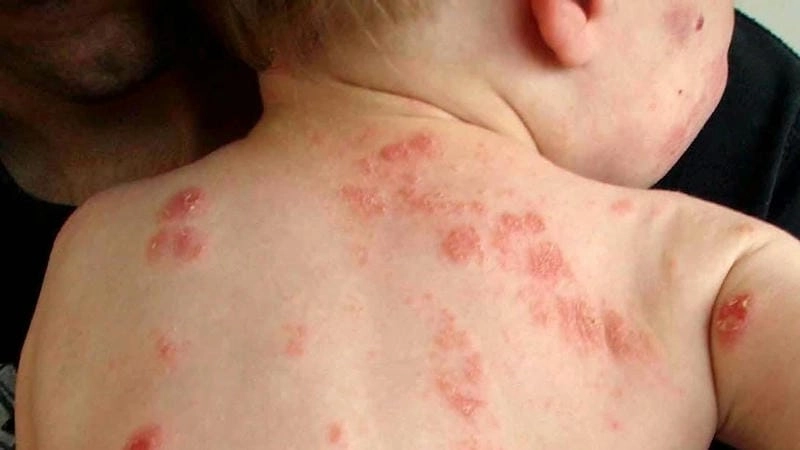 Thông tin nhận biết và chăm sóc eczema cơ bản