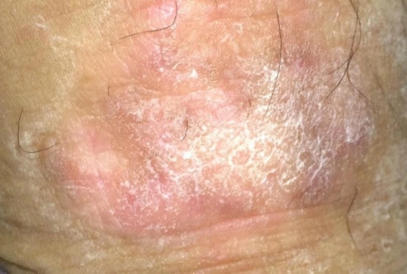 Hình ảnh người bị bệnh eczema thực tế