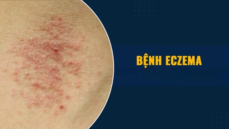 Biểu hiện thường gặp của bệnh chàm eczema