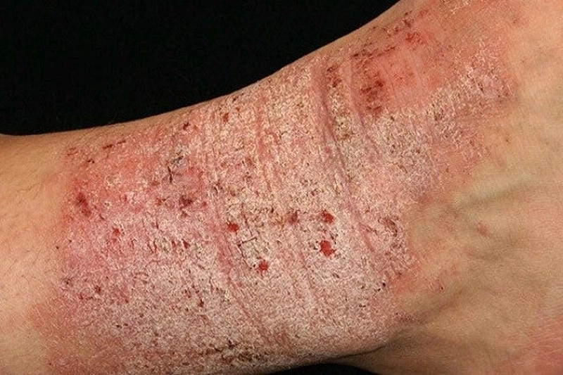 Giải thích benh eczema la gi dễ hiểu