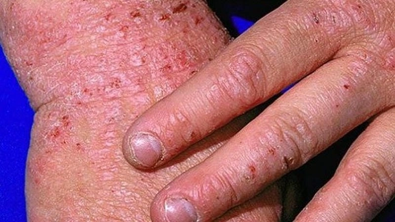 Dấu hiệu bệnh eczema tổ đỉa ở tay chân