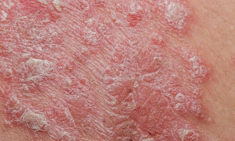 Biểu hiện eczema vi khuẩn và hướng xử lý