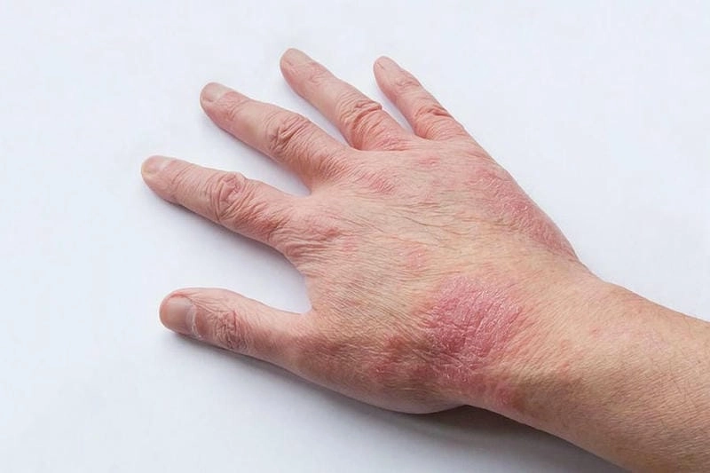 Hình ảnh và dấu hiệu eczema đồng tiền thường gặp