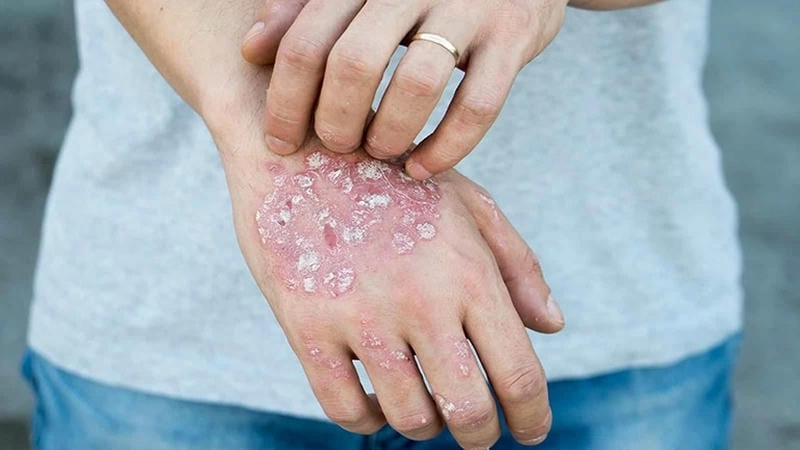 Hình ảnh bệnh eczema ở người dễ nhận biết