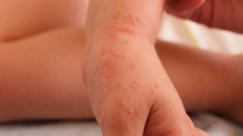 Hình ảnh nhận biết bệnh tụ huyết trùng ở lợn