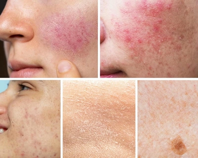 Ảnh người bị bệnh nấm da mặt phổ biến hiện nay