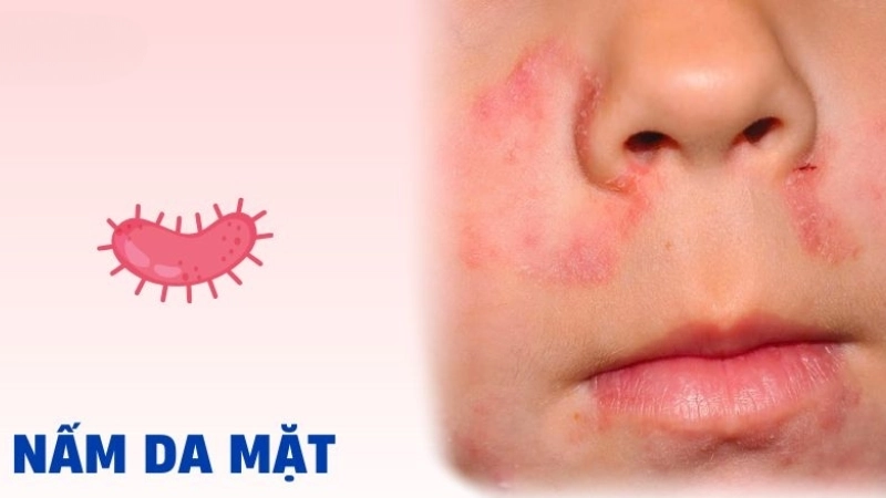 Nấm da mặt ở trẻ em thường gặp hiện nay
