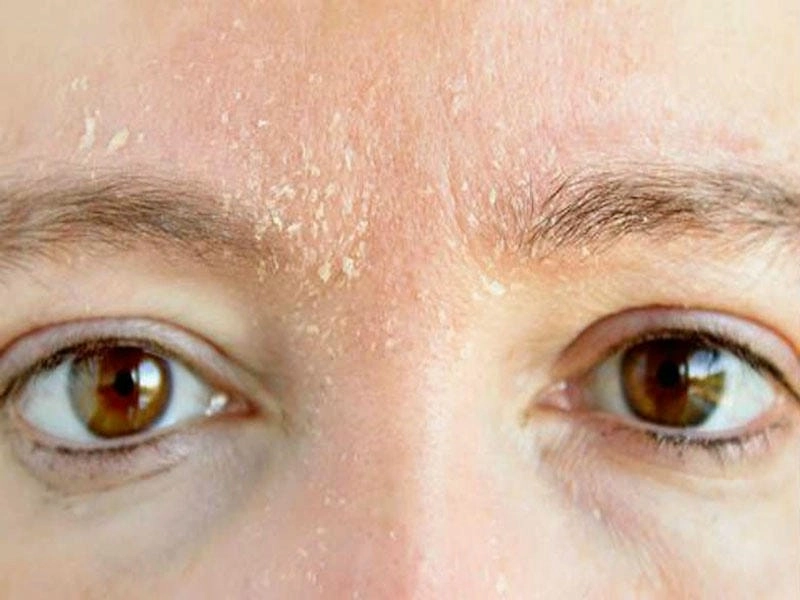 Hiện tượng nấm da mặt thường gặp ở nhiều người