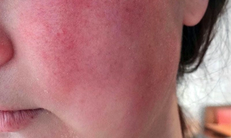 Hình ảnh người bệnh nấm da mặt rõ ràng chi tiết
