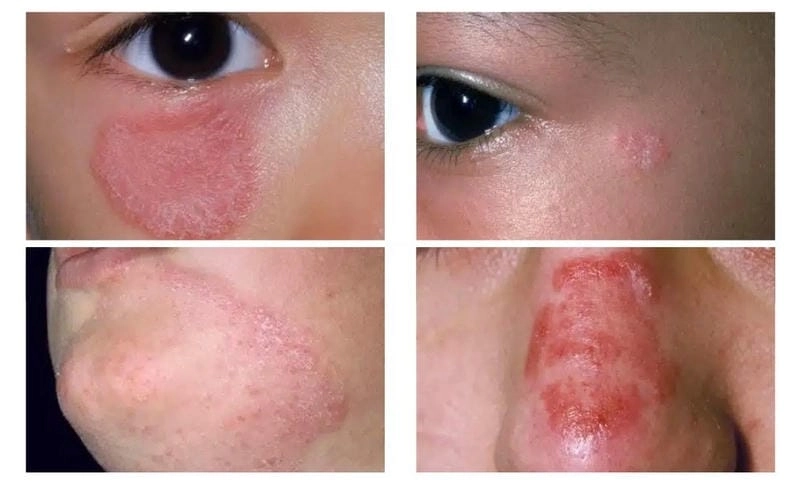 Hình ảnh người mắc bệnh nấm da mặt thường gặp